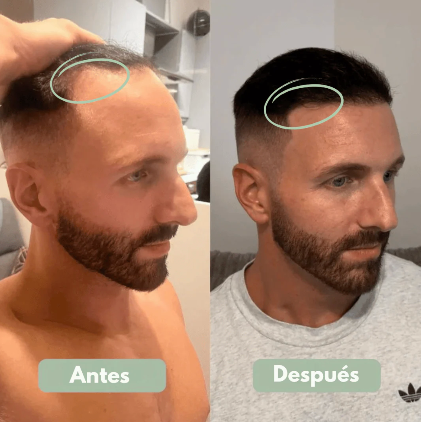 3X1 ✅Serum Roll-On para el Crecimiento Capilar - Reverse