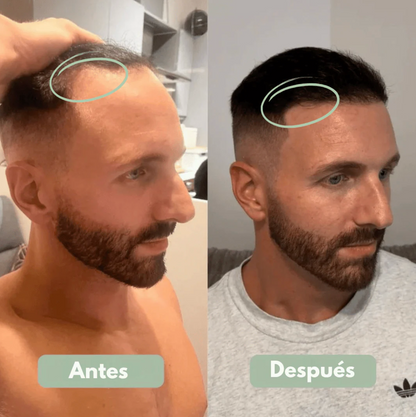 3X1 ✅Serum Roll-On para el Crecimiento Capilar - Reverse